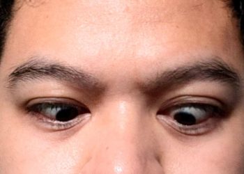 9 Gejala Strabismus, Penyebab dan Cara Penanganannya