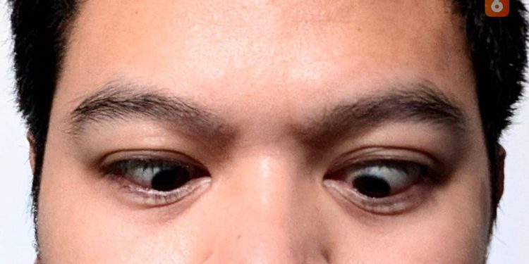 9 Gejala Strabismus, Penyebab dan Cara Penanganannya