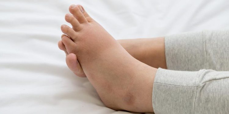 Kaki Bengkak Akibat Kerusakan Ginjal dan Ciri-cirinya