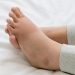 Kaki Bengkak Akibat Kerusakan Ginjal dan Ciri-cirinya