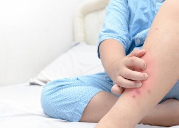 Bercak Merah di Kulit Tanpa Gatal? Kenali 7 Penyakit yang Mungkin Terjadi