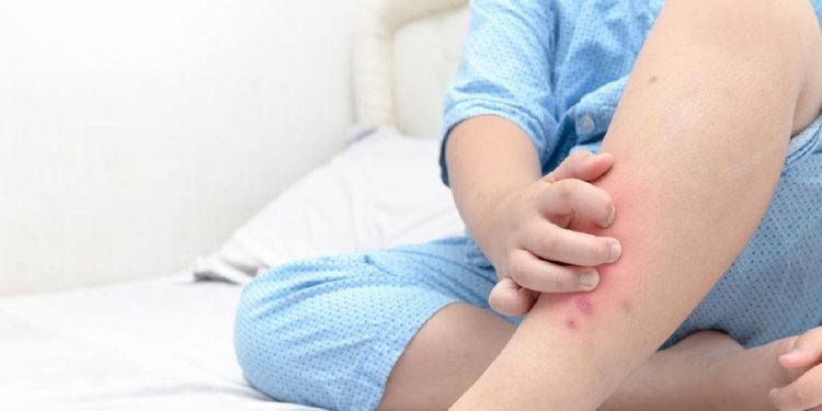 Bercak Merah di Kulit Tanpa Gatal? Kenali 7 Penyakit yang Mungkin Terjadi