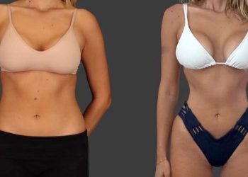 Fenomena Tubuh Ozempic, Wanita Nekat Operasi Buang Tulang Rusuk demi Pinggang Ramping