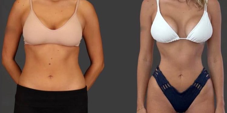 Fenomena Tubuh Ozempic, Wanita Nekat Operasi Buang Tulang Rusuk demi Pinggang Ramping