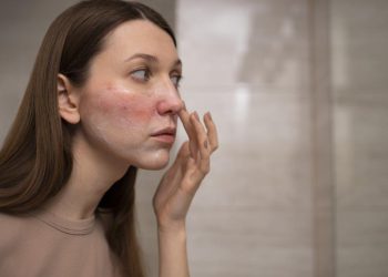 Rosacea Penyebab Wajah Merah Berkepanjangan Gejala dan Cara Mengatasinya