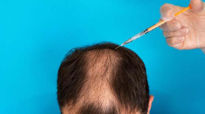 Transplantasi Rambut: Harapan Mengatasi Kerontokan dan Risiko Tersembunyi yang Jarang Diketahui