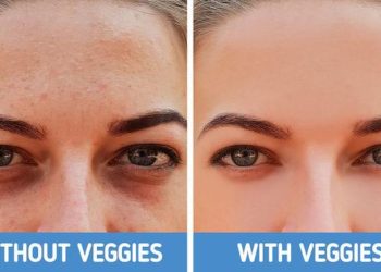 Kenali 4 Tipe Lingkaran Hitam di Bawah Mata dan Cara Efektif Mengatasinya