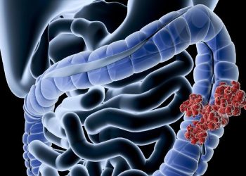 Gen Z Rentan Kanker Usus Besar, Makanan Ini Jadi Penyebab Utamanya