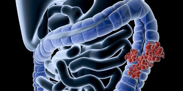 Gen Z Rentan Kanker Usus Besar, Makanan Ini Jadi Penyebab Utamanya